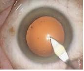 opration cataracte incision