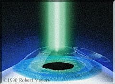 lasik-laser-excimer