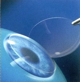 Lasik. Volet. Capot.