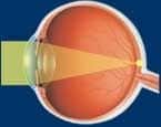oeil-normal-focalisation-image-retine