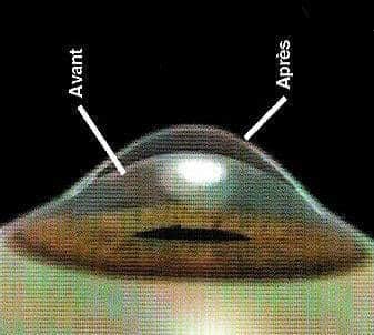 operation-hypermetropie -laser-lasik