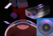 chirurgie-refractive-laser-lasik-eye-tracker