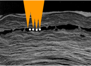 Lasik-femtoseconde-bulles-gaz. 