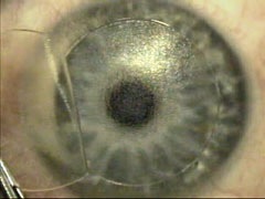 operation-hypermetropie-lasik-volet-large