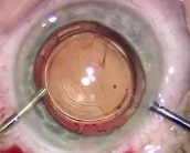 Operation-cataracte-implant-post-lasik