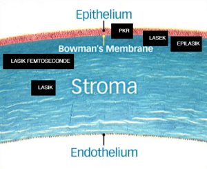 PKR-LASIK- profondeur-ablation
