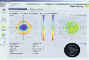 lasik-examen-pre-operatoire-aberrometrie-aberrations-optiques