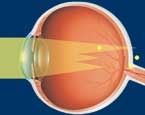 oeil-astigmate-schema-rayons