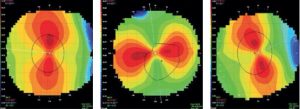 astigmatisme-topographie-corneenne-pre-operatoire