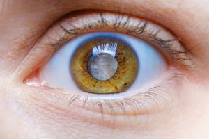 operation-cataracte-avant-chirurgie-examen-cristallin