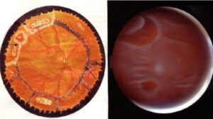 cerclage-laser-retine-dechirure-decollement