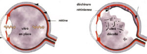 decollement-vitre-corps-flottants