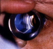 operation-cataracte-examen-retine-fond-oeil-verre-3-miroirs
