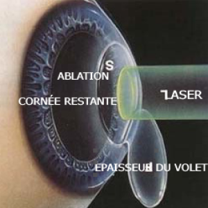 lasik-epaisseur-cornee-restante-apres-decoupe-volet