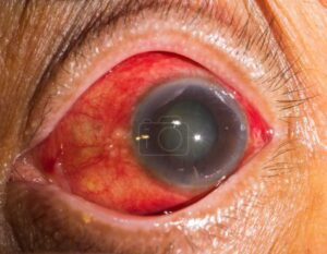 glaucome-aigu-oeil-rouge-tension-oculaire-elevee