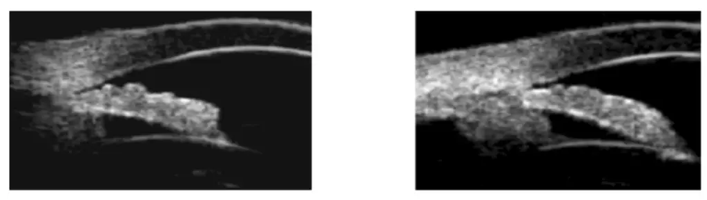 glaucome-angle-ouvert-etroit