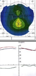 hypermetropie-topographie-corneenne-avant-operation-laser-Cornee-courbure-normale