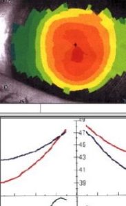 hypermetropie-topographie-corneenne-apres-operation-laser.-Cornee-bombee