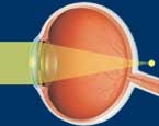 oeil-hypermetrope-image-en-arriere-retine