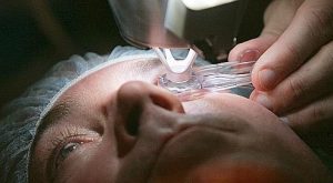 anneau-succion-cataracte-laser-femtoseconde
