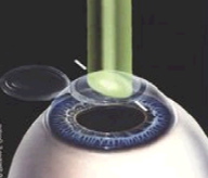 operation-astigmatisme-laser-lasik