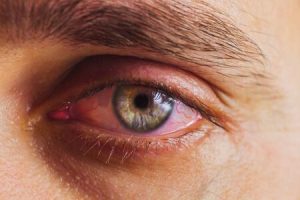 operation-myopie-oeil-rouge-inflammation-keratite