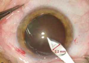 operation-cataracte-incision-astigmatisme