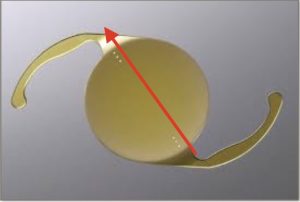 operation-cataracte sans-lunettes-astigmatisme-implant-torique-photo