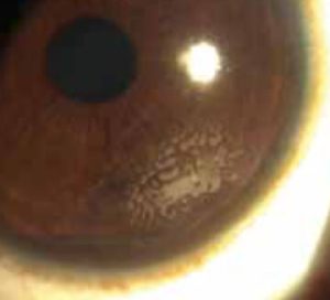 operation-myopie-complication-invasion-epitheliale