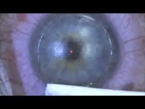 Opération de myopie par Lasik