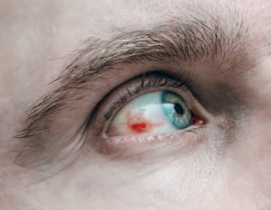 operation-myopie-lasik-hemorragie-conjonctivale