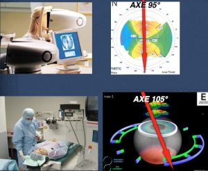 chirurgie-astigmatisme-laser-axe