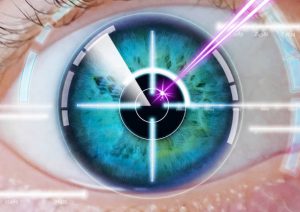 chirurgie-refractive-laser-myopie-presbytie
