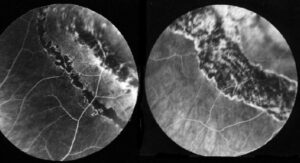 traitement-laser-retine